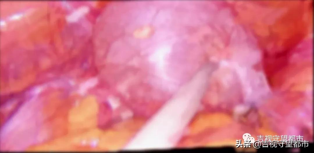 十几岁孩子得了卵巢囊肿,女子小腹大去检查卵巢囊肿