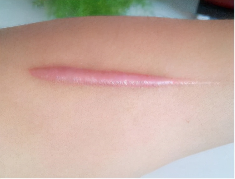 祛除凸疤最有效的方法,脸上有增生凸疤怎么办