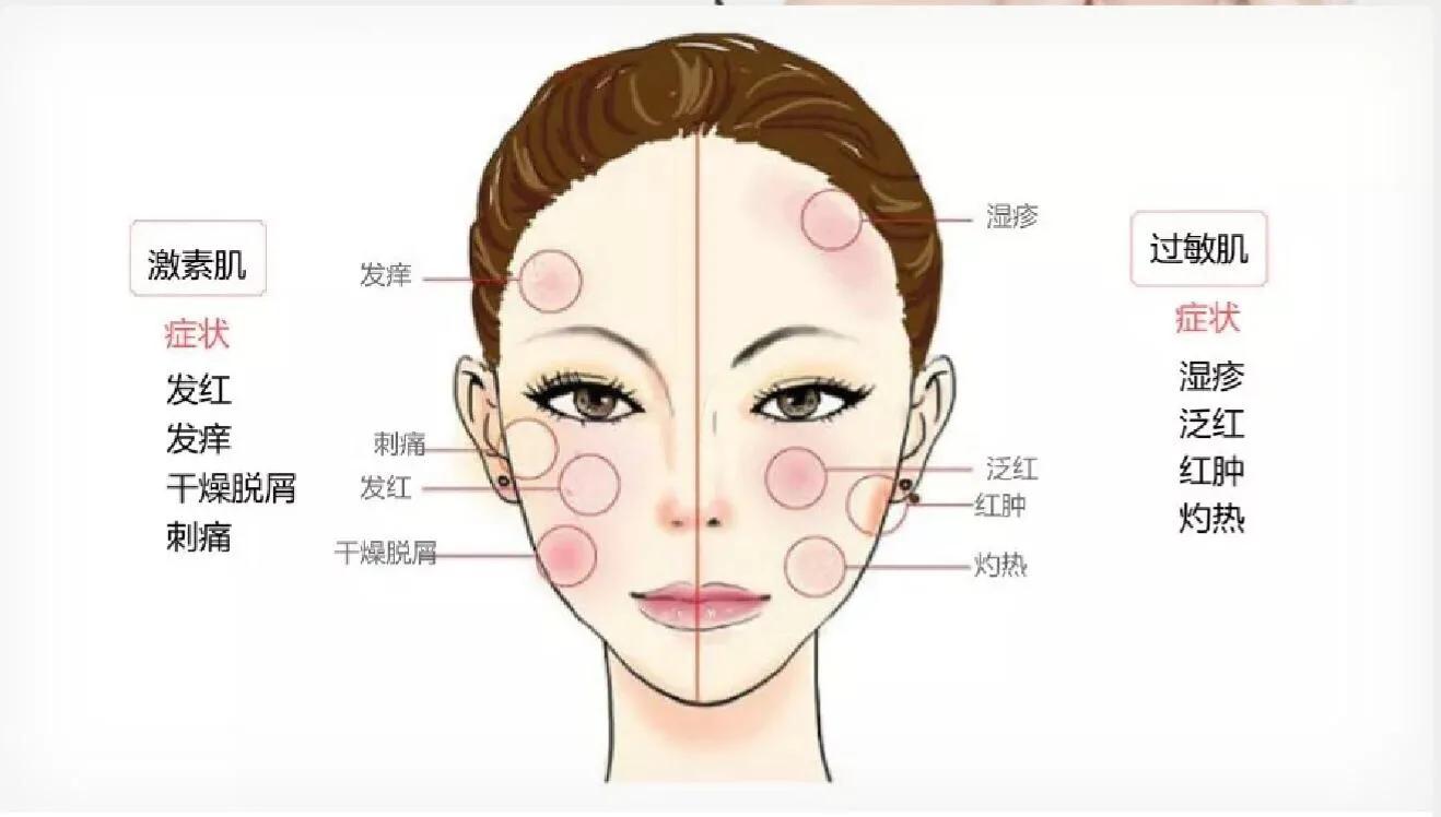 如何辨别激素脸讲座,土办法治激素脸