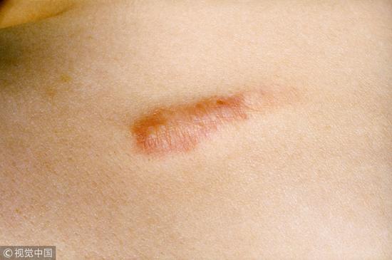 伤口结痂了防止留疤的小妙招,伤口愈合后疤痕凸起注意事项