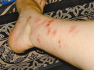 臭虫咬伤最快治疗方法,臭虫咬伤用什么药治好得很快