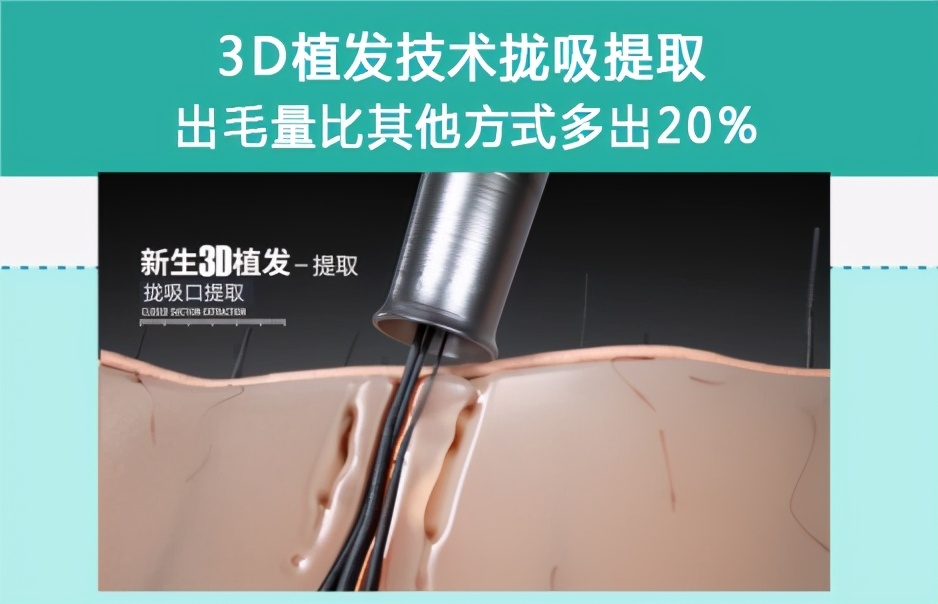 脱发正向大学生等更年轻化群体蔓延别慌!无锡新生植发来拯救