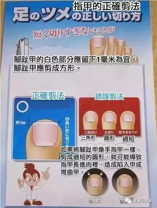 脚趾甲已经剪成圆形怎么办,脚趾甲长进肉怎么剪才不会痛