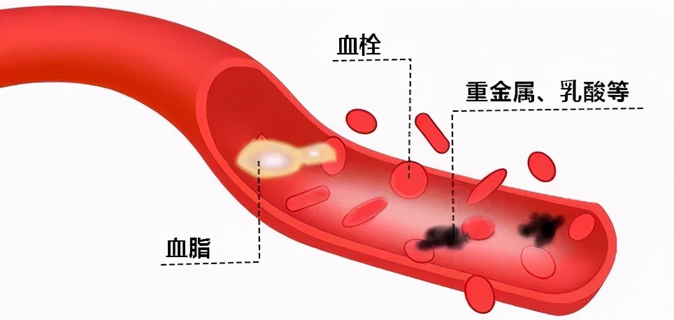 人的血管过大怎么办,血管怎么保养和清理