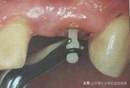 纤维桩修复费用,纤维桩修复全过程视频