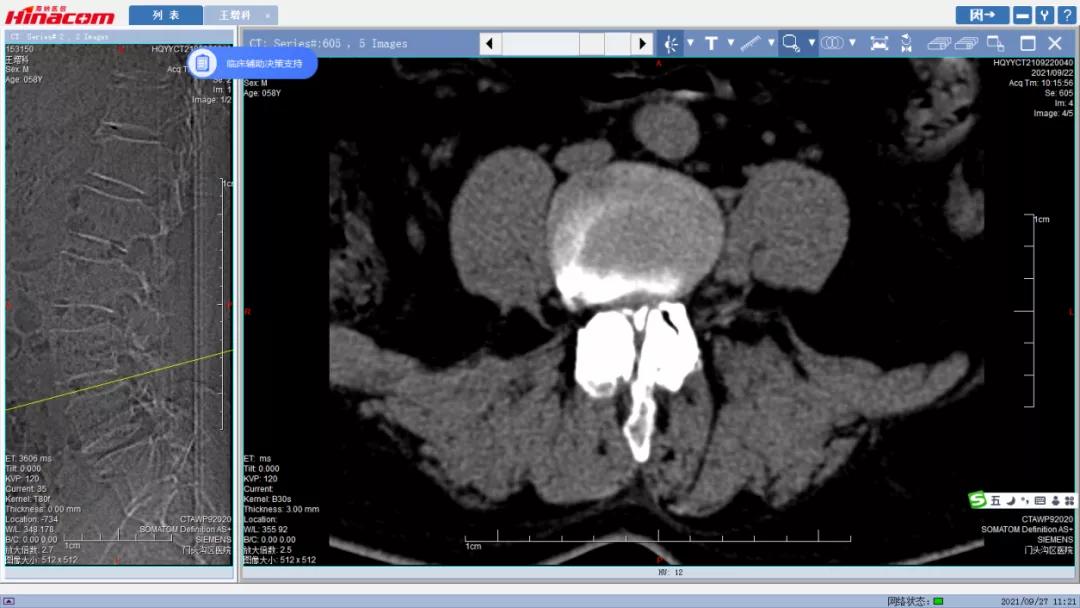 再也不用歪着身子走路了—区医院脊柱中心（骨二科）成功实施腰椎间盘摘除、椎间植骨融合钉棒内固定术