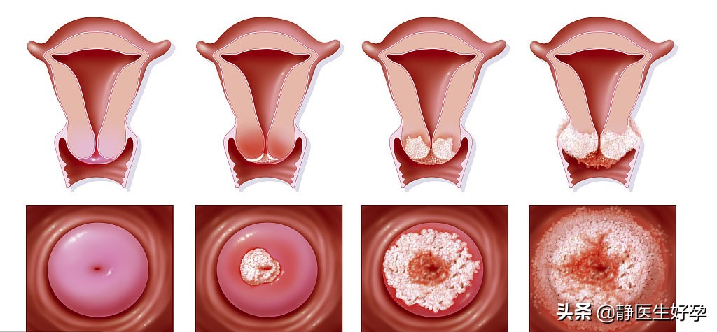 轻度宫颈糜烂对备孕有影响吗,静医生备孕团队调理成功率