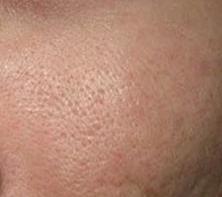 男皮肤粗糙毛孔粗大改善方法,青少年皮肤粗糙毛孔粗大改善方法