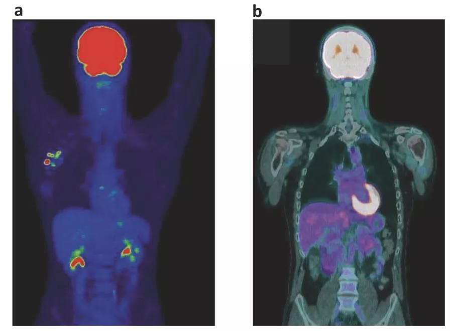 鼻咽癌晚期怎么治疗效果好,鼻咽癌晚期最新疗法