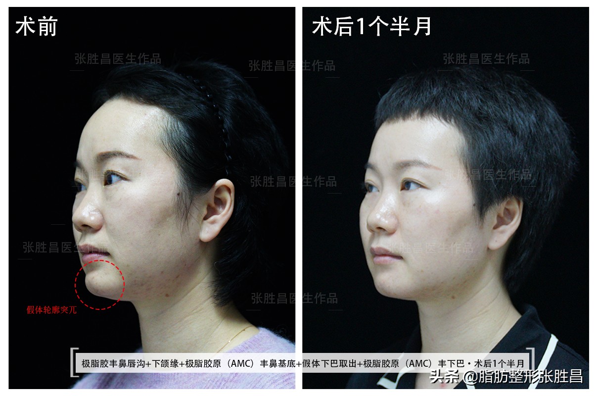 7年前做的下巴假体能取出吗,7年前做过假体隆胸手术