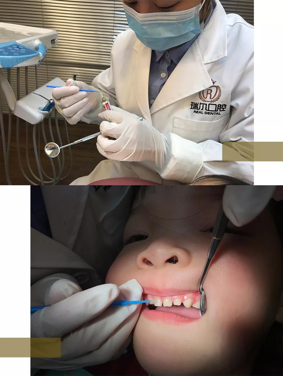 3岁宝宝牙齿需要做什么,三岁宝宝治疗牙齿过程