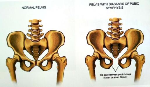 产后收胯骨盆矫正推荐,产后屁股大胯宽凹陷下垂怎么恢复