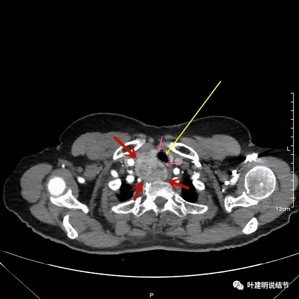 胸部高分辨ct检查注意事项,胸部ct扫描有没有危害