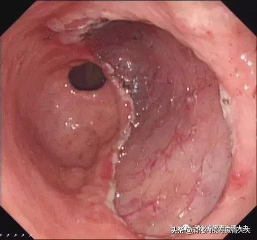 关于胃原位癌的科普文章,消化道早癌科普文章