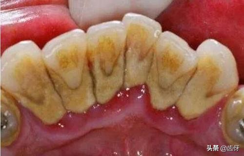 洗牙谣言,为什么很多人对洗牙有误解