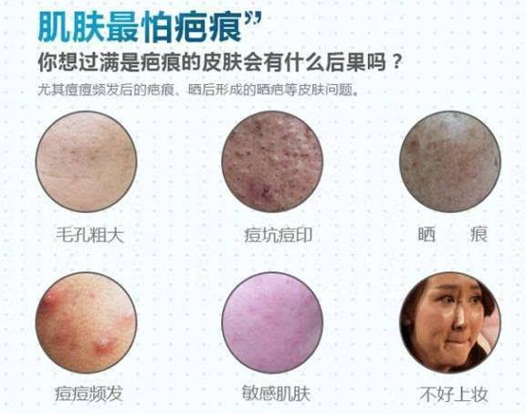 个别痘里面有白脓能挤吗,脓包型痘痘如何排出脓液