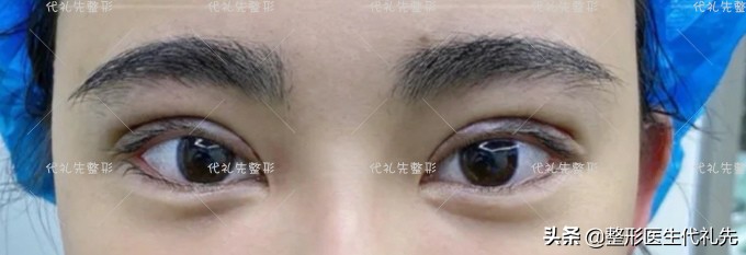 新月形双眼皮好看还是扇形好,新月型与平扇形双眼皮的区别