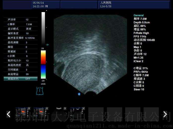 微创人流手术个人经历记录,做微创人流手术的真实感受