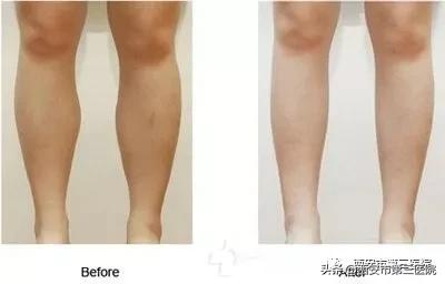 肉毒素能美白皮肤吗,肉毒素在医学美容的作用