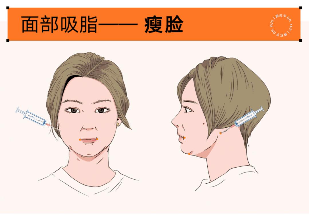 面部吸脂可以瘦脸,面部吸脂全脸什么部位不能吸