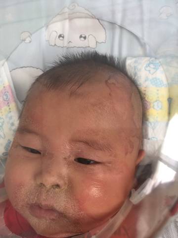 葡萄球菌性烫伤样皮肤综合征表现,葡萄球菌性烫伤样皮肤综合征原因