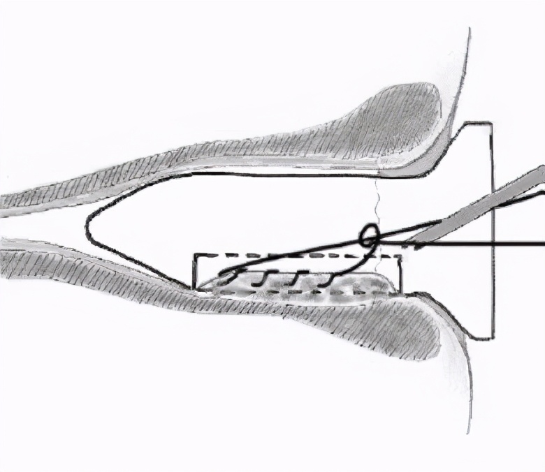痔疮手术出院后可以不复查吗,痔疮手术后不排便可以出院吗