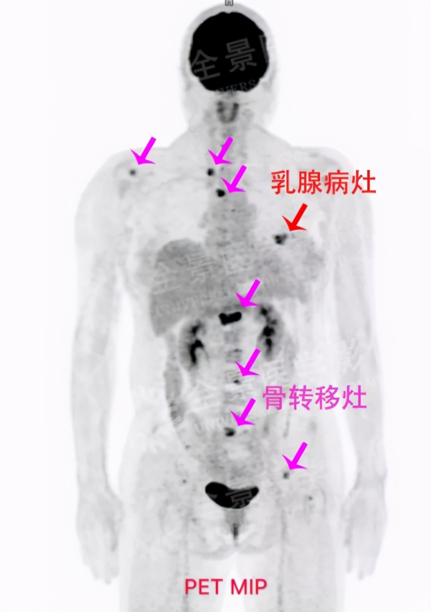 乳腺bi-rads分类有哪些,乳腺bi-rads的分类