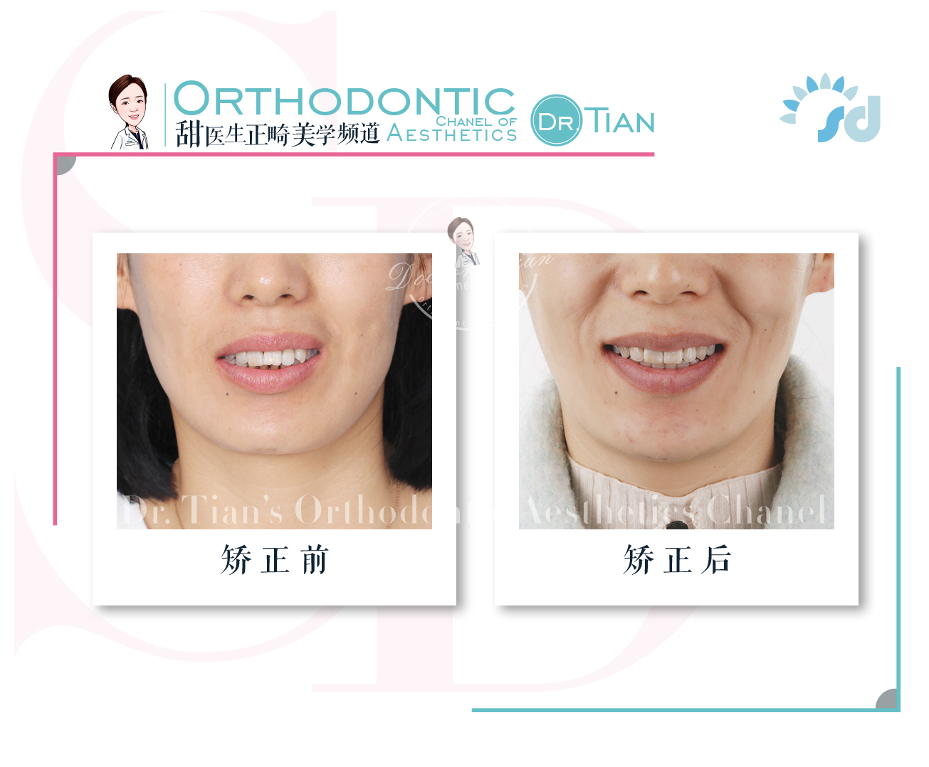 西安哪里有做牙齿矫正,在西安哪里可以做牙齿矫正