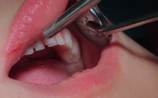 3岁宝宝牙齿需要做什么,三岁宝宝治疗牙齿过程