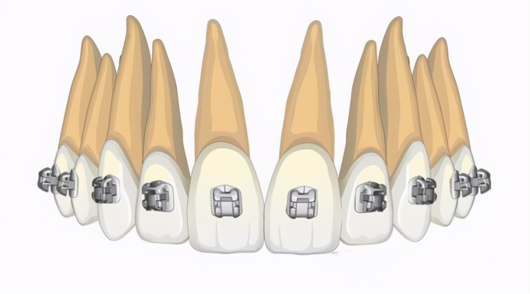 牙齿矫正需要注意哪些消费陷阱,矫正牙齿怎么避免隐形收费