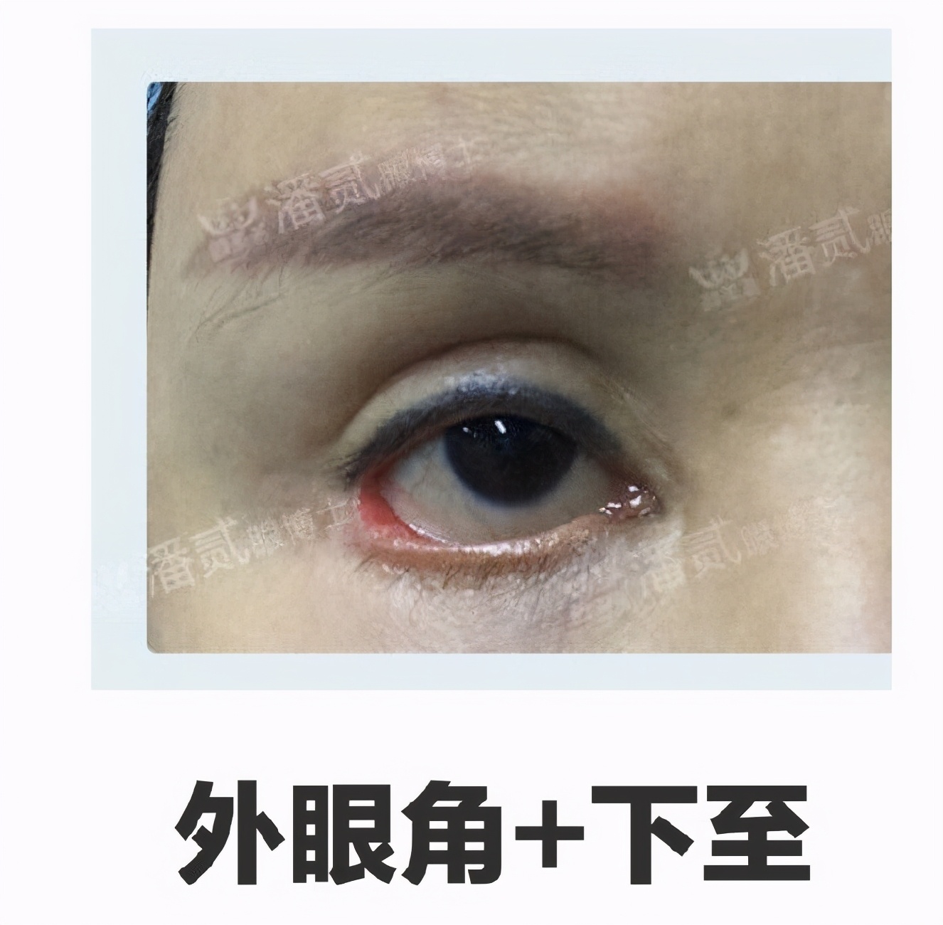 开外眼角结膜充血水肿怎么办,眼睛开外眼角有后遗症吗