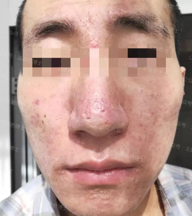 魔幻案例：出身医学世家，却靠求神拜佛来治疗痘痘