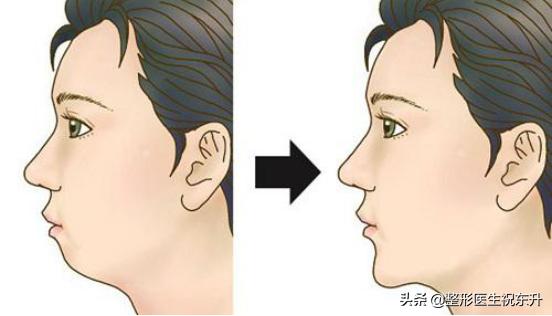 关于玻尿酸丰下巴的那些事...