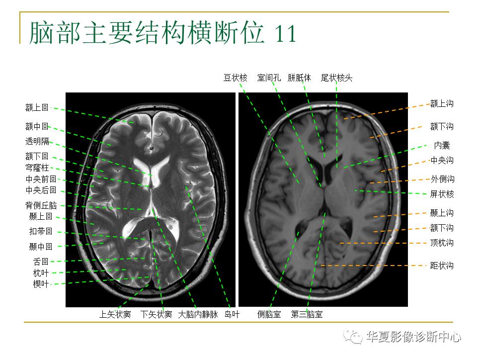 中国人脑立体定向mri应用解剖图谱,脑mri示意图
