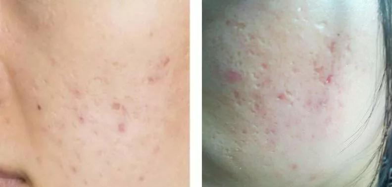 痘印痘坑怎么消除医美,十几年痘印痘坑消除的方法