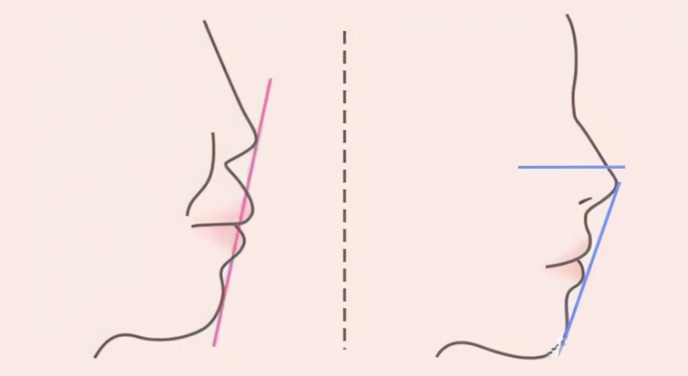 嘴凸牙齿矫正前后对比视频,牙齿矫正拔智齿可以怎样改善嘴凸