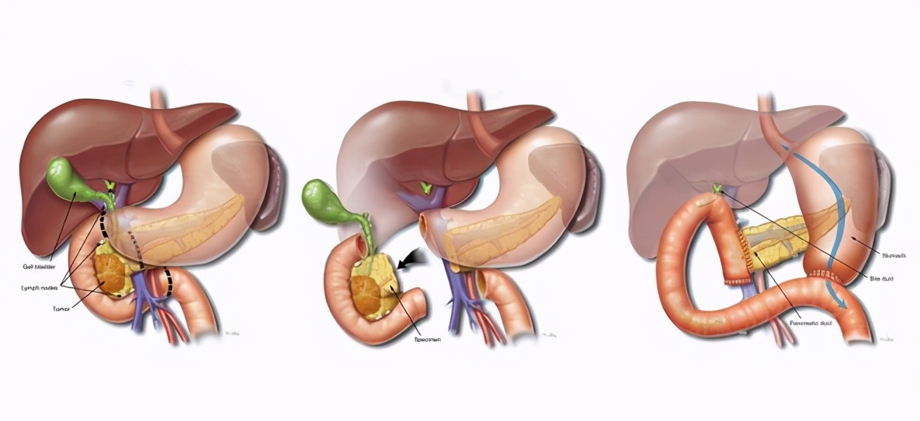 把胃全部切了能吃啥,把胃全部切除还能吃饭吗