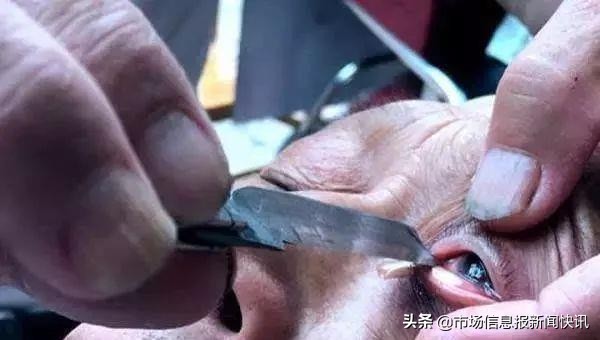 成都刀锋洗眼洗出虫子,刀锋洗眼可以做吗