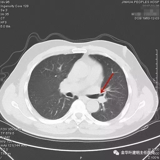 不典型鳞状细胞不明确可怕吗,不典型性鳞癌是什么