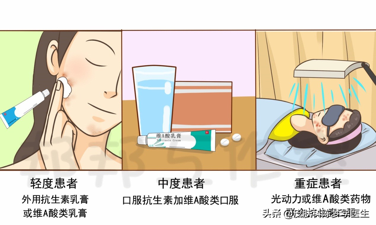 碘伏治疗痘痘,碘伏治疗痘痘好方法