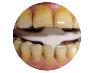 牙齿发黄如何变白有什么方法,牙齿发黄怎么办教你一招变白