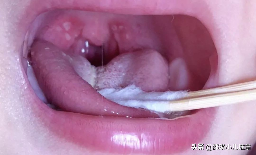 孩子得了疱疹性咽颊炎，怎么做才能好得快？