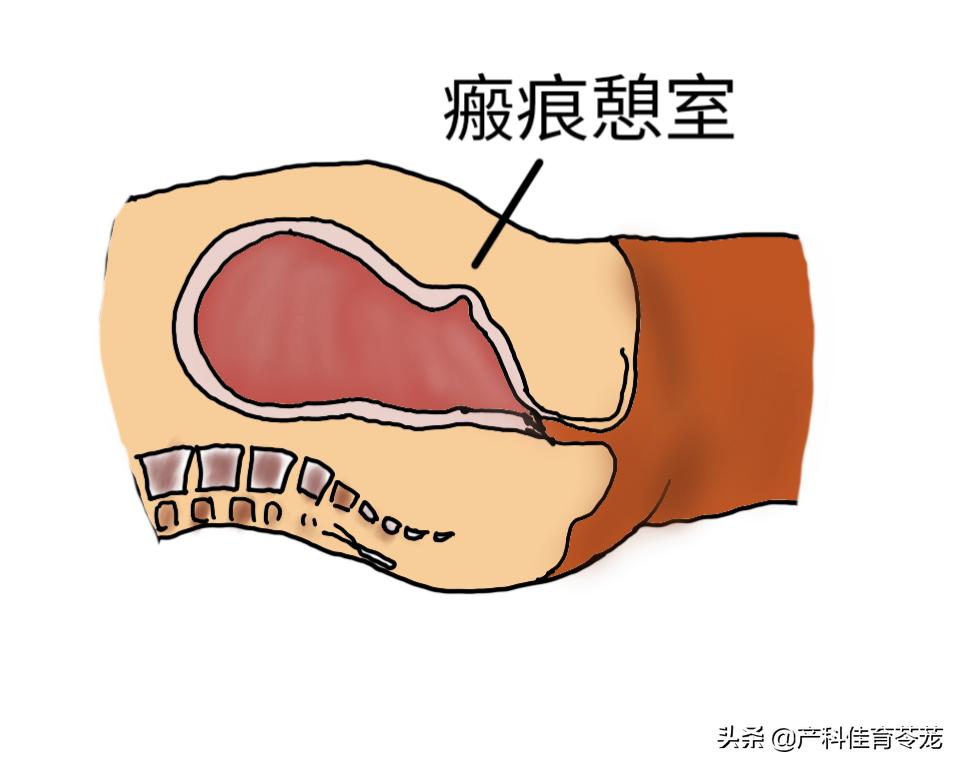 剖宫产瘢痕憩室的症状怎么治,瘢痕憩室术后并发症