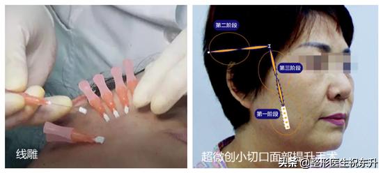 线雕15天脸部凹陷越来越严重,小切口和线雕有什么区别