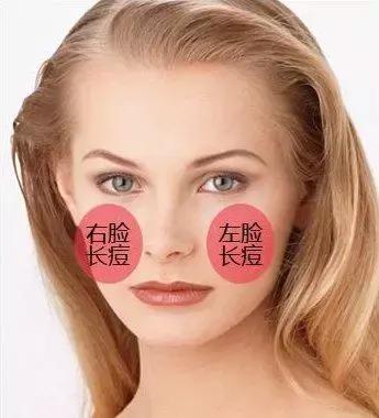 脸上反反复复长痘怎么调理,脸上一年都长痘的原因和解决方法