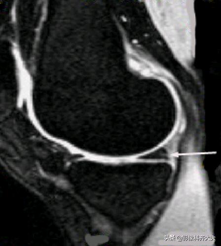 膝关节半月板损伤的磁共振,膝关节半月板病变的mri诊断与鉴别