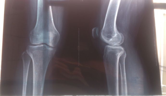 腰椎骨质增生正确康复锻炼方法,什么是膝盖增生