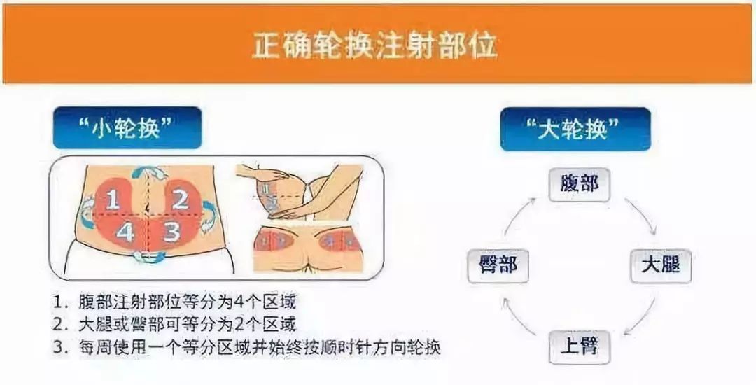佩戴胰岛素泵如何平稳血糖,糖友怎么自己打针