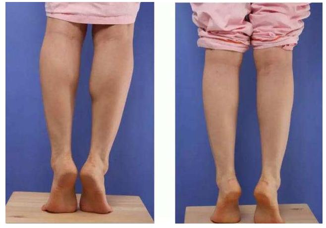 肌肉腿塑形的烦恼,怎么改善脂肪型肌肉腿