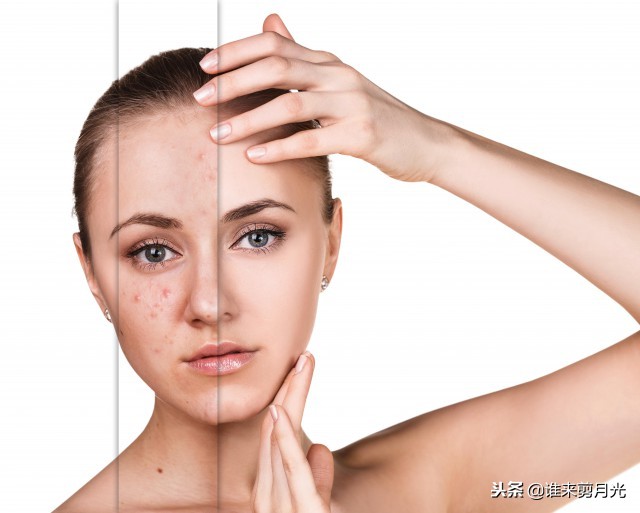 嘴巴下面反复长痘痘怎么回事,嘴巴下面老是长痘痘怎么回事